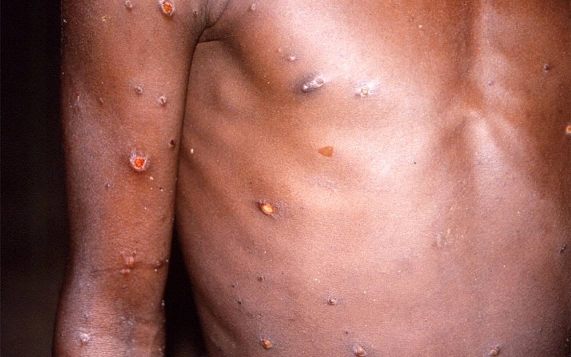 Possible case of monkey smallpox detected in Florida – El Sol de México